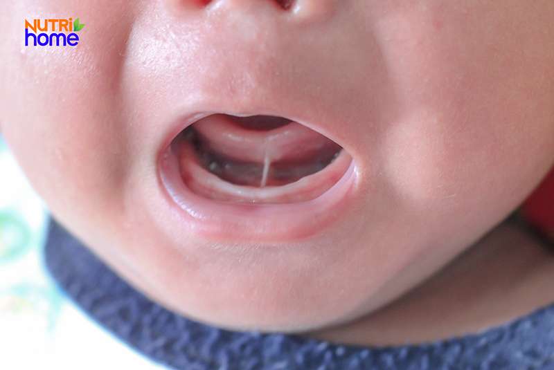 Dính tưa lưỡi gì, nguyên nhân tưa lưỡi ở trẻ