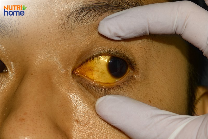 Chẩn đoán bệnh viêm gan virus, dấu hiệu lâm sàn, vàng da vàng mắt