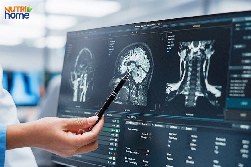 Phương pháp chẩn đoán đau đầu, chụp mri