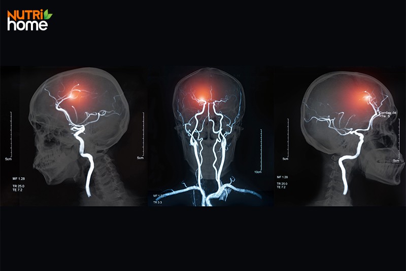 Thường xuyên đau đầu là bệnh gì?