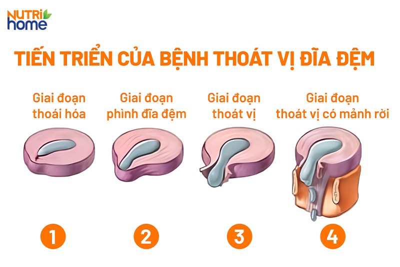 Các giai đoạn thoát vị đĩa đệm
