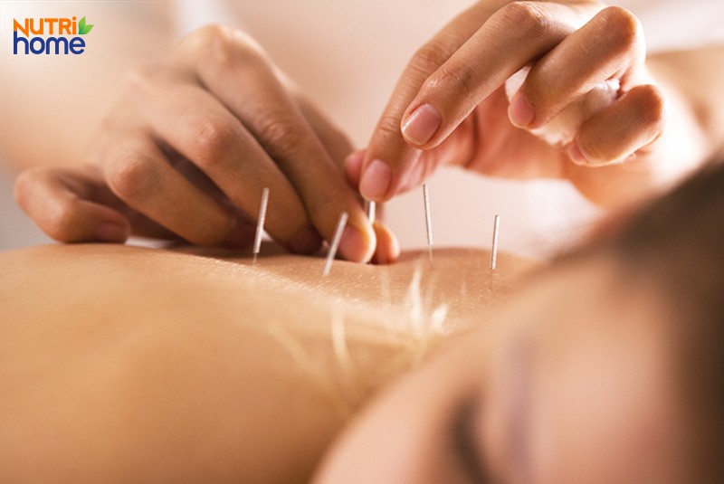 điều trị rối loạn giấc ngủ, châm cứu