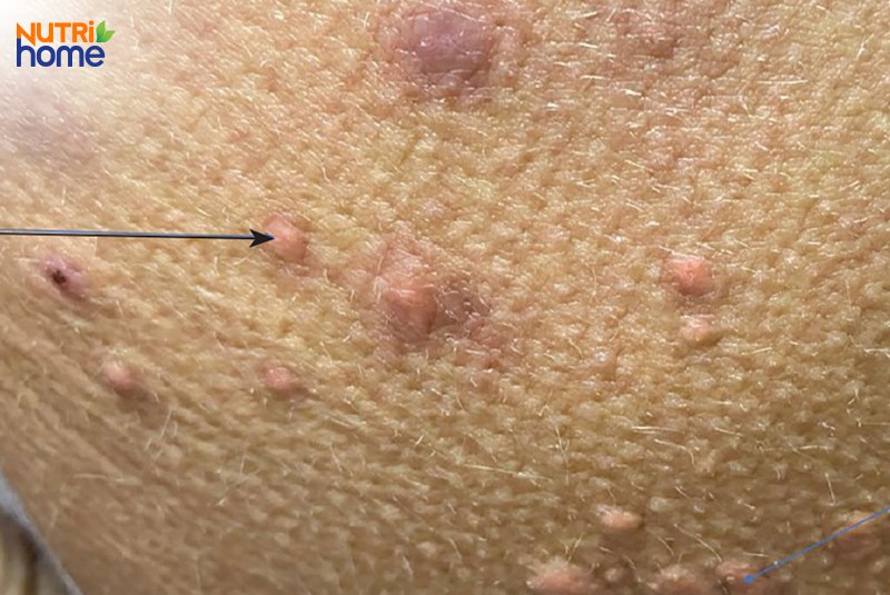 Dấu hiệu triglyceride cao là gì?