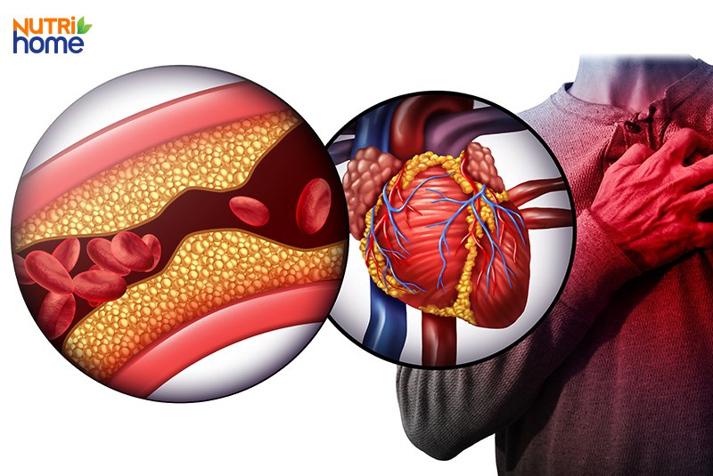 Triglyceride cao có nguy hiểm không?