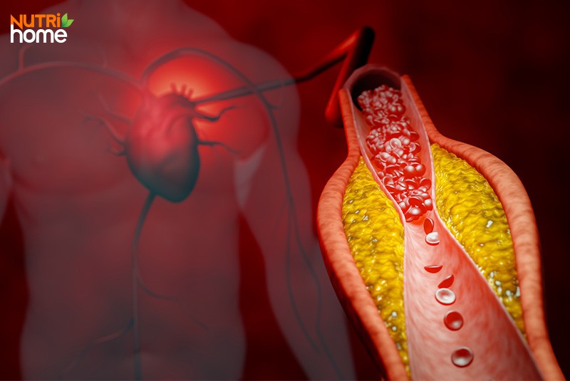 Rối loạn lipid máu có nguy hiểm không?