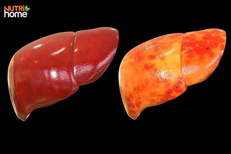 Các bệnh rối loạn chuyển hóa ở người thường gặp, gan nhiễm mỡ