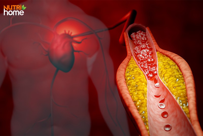 Rối loạn lipid máu kiêng ăn thực phẩm nhiều chất béo bão hòa