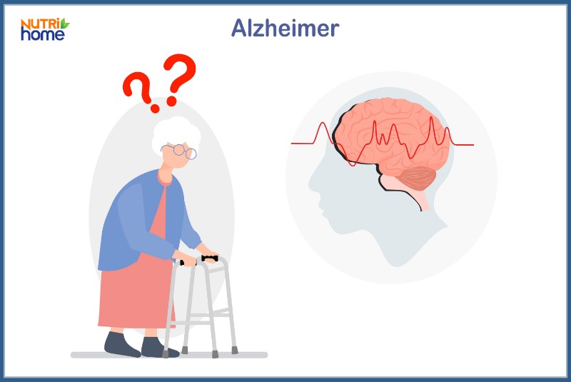 Những bệnh lý thường gặp ở não, Bệnh thoái hóa thần kinh, Alzheimer