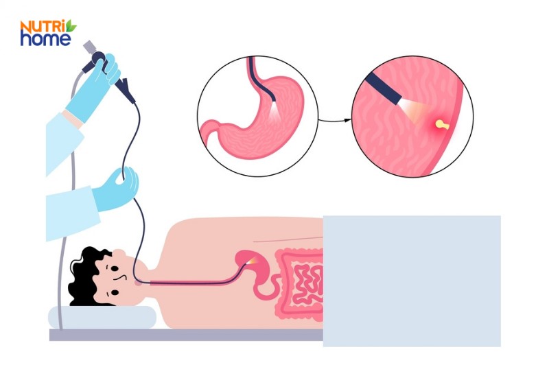 Nội soi chẩn đoán viêm trợt dạ dày