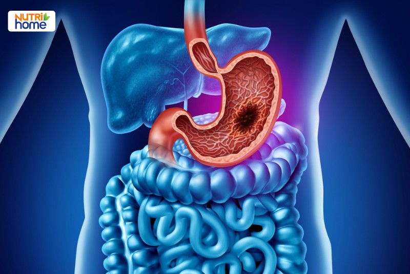 Những bệnh lý thường gặp ở dạ dày, ung thư dạ dày