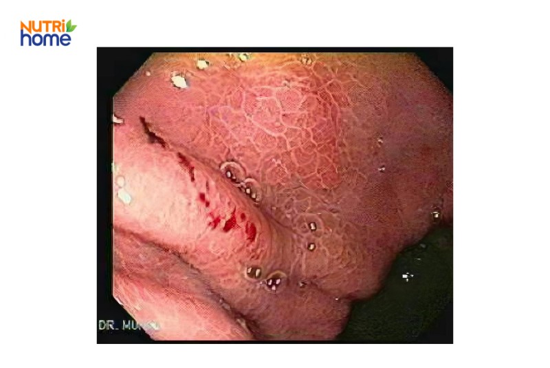 Dấu hiệu viêm xung huyết hang vị dạ dày