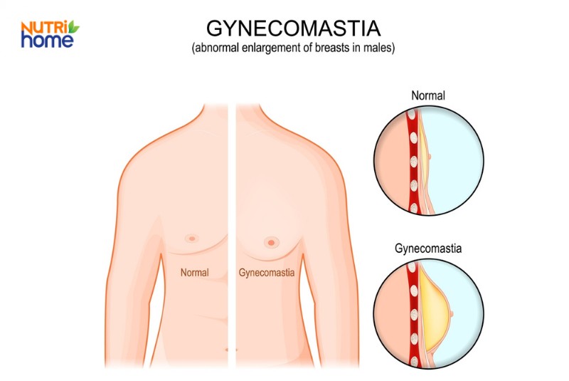 Phì đại (nữ hóa) tuyến vú ở nam giới