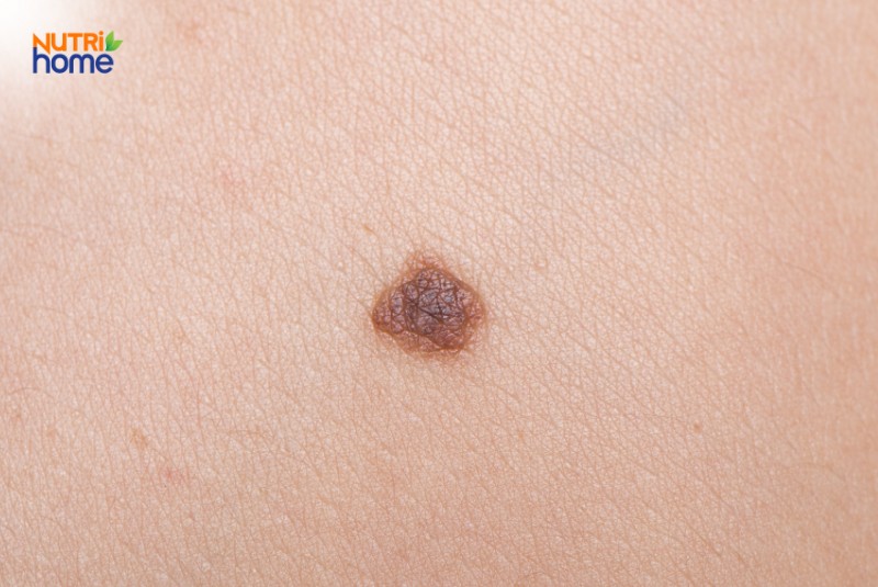 Các loại u lành tính, U tế bào hắc tố