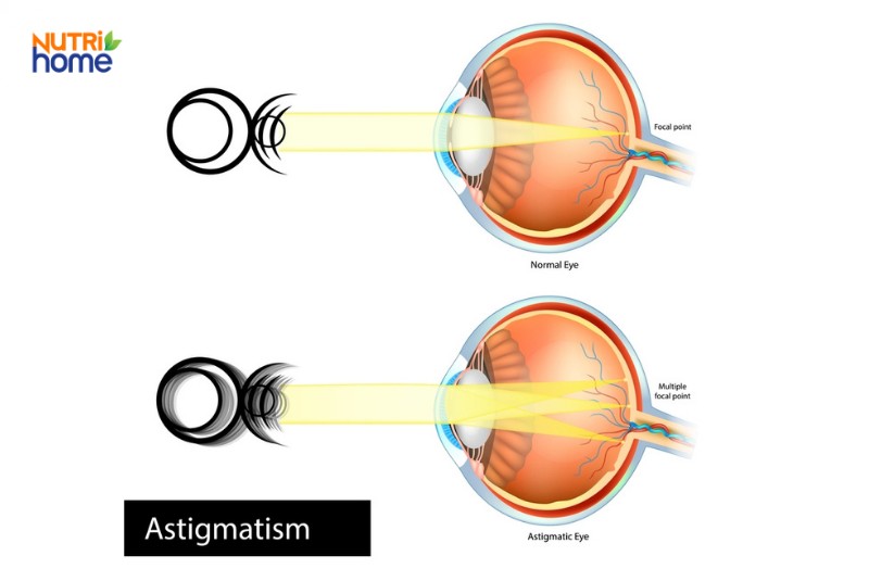 dấu hiệu loạn thị
