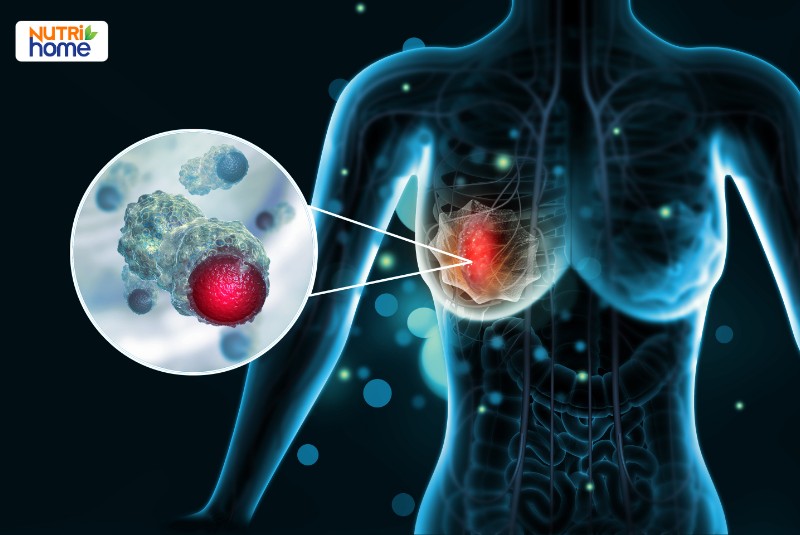 U vú ác tính khác u vú lành tính thế nào?