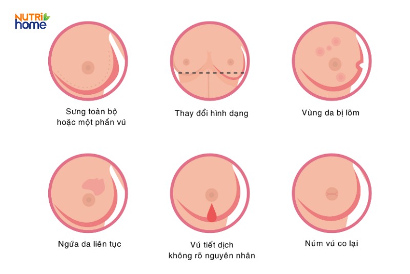 Dấu hiệu u vú ác tính thường gặp