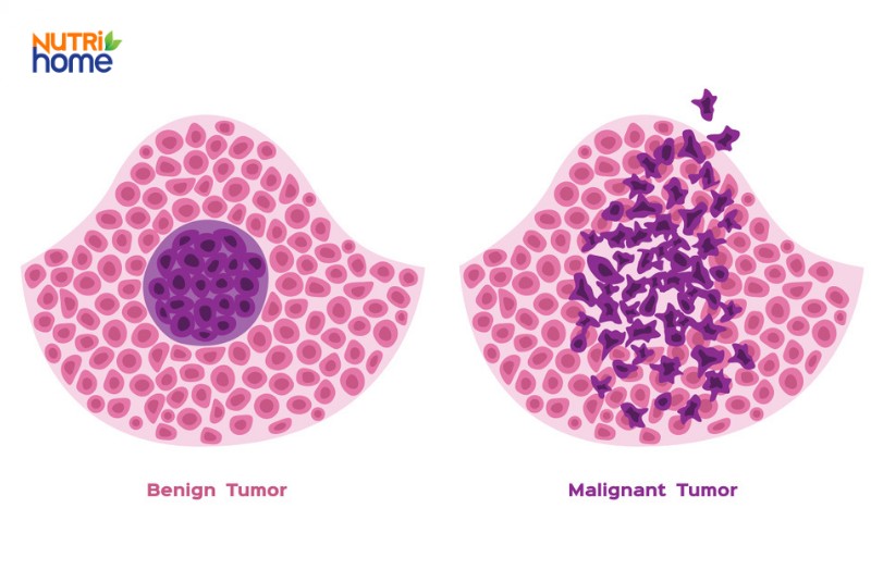 U lành có di căn không?