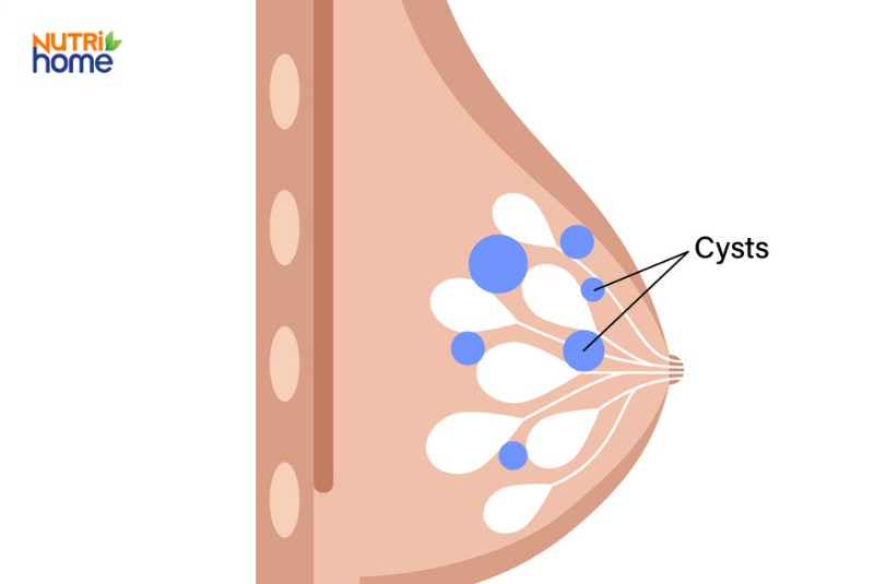 Các loại khối u ở vú, u vú lành tính
