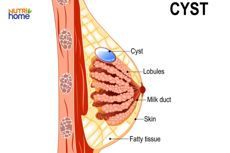 Các bệnh về vú thường gặp, u nang vú