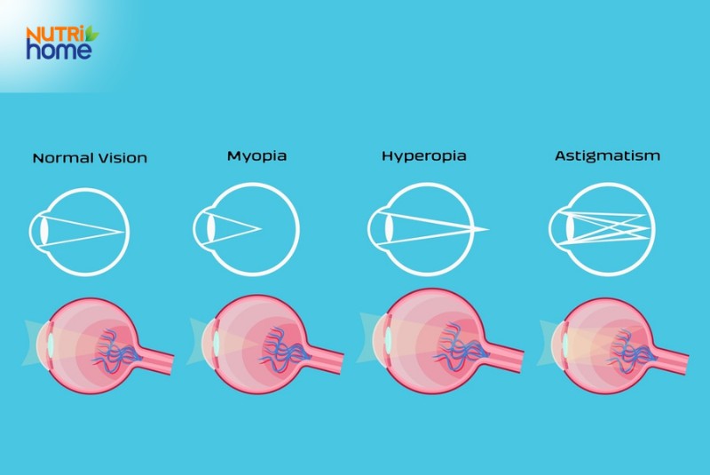 Nguyên nhân tật khúc xạ là gì?