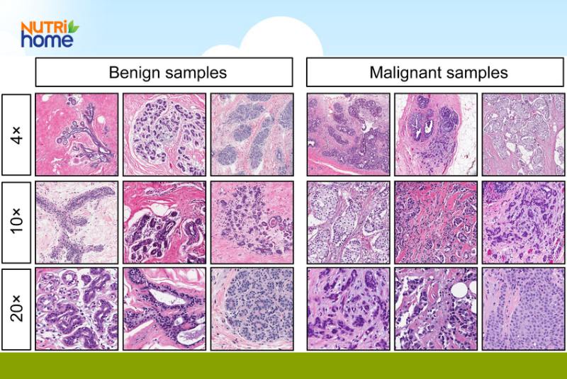 Phân biệt u lành và u ác