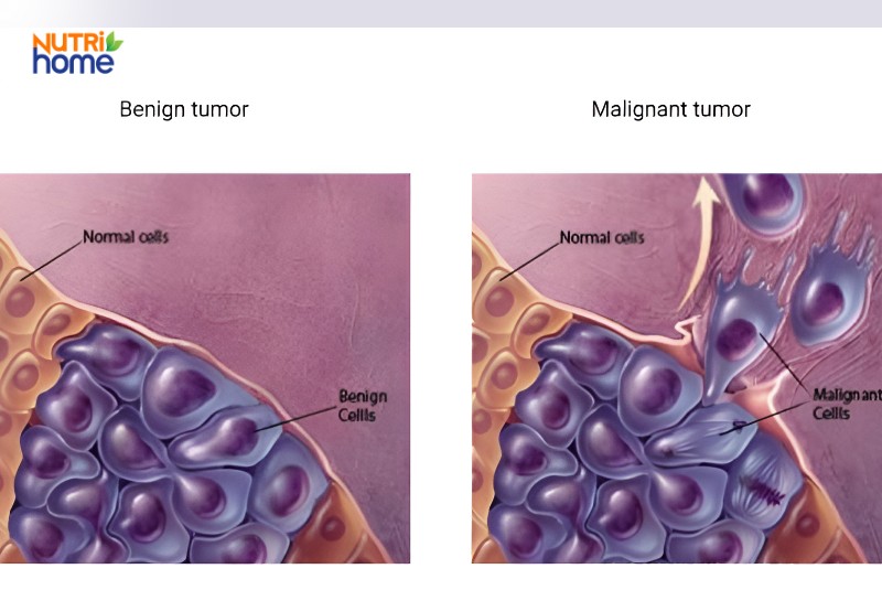 U ác tính là gì?