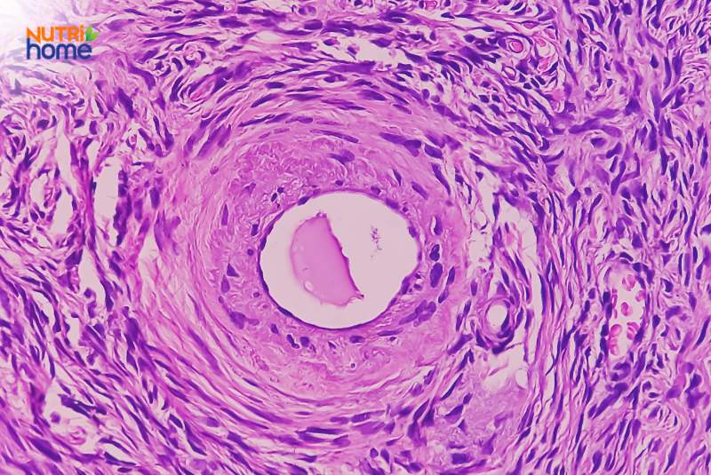 U lành tính là gì?