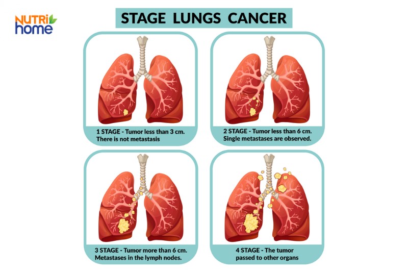 Các giai đoạn của bệnh ung thư phổi
