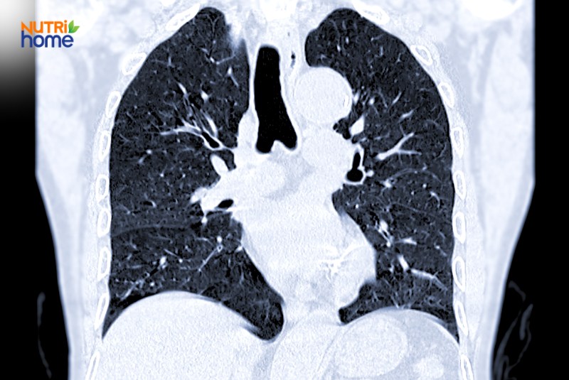 Chẩn đoán ung thư phổi