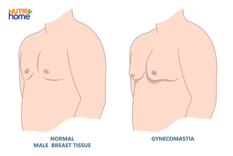triệu chứng ung thư phổi, Vú to bất thường ở nam giới