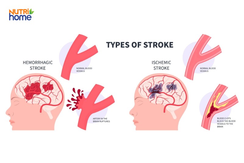 Các loại đột quỵ não