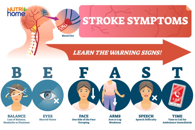 Nhận biết dấu hiệu đột quỵ bằng quy tắc FAST