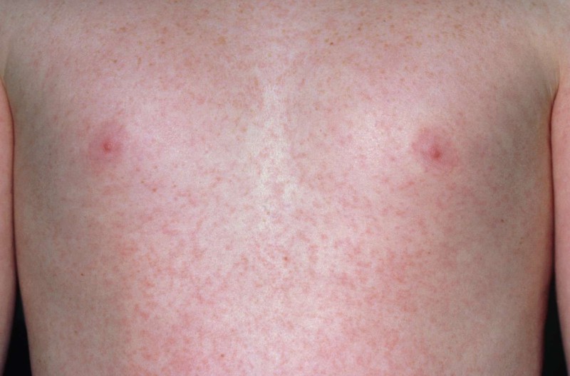 Vắc xin Sởi – Quai bị – Rubella tiêm trước khi mang thai
