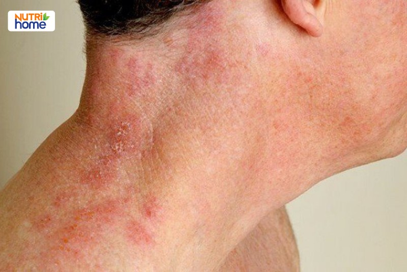 bị zona thần kinh