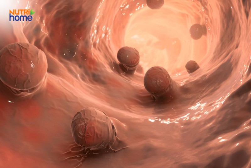 dấu hiệu bệnh trực tràng, polyp
