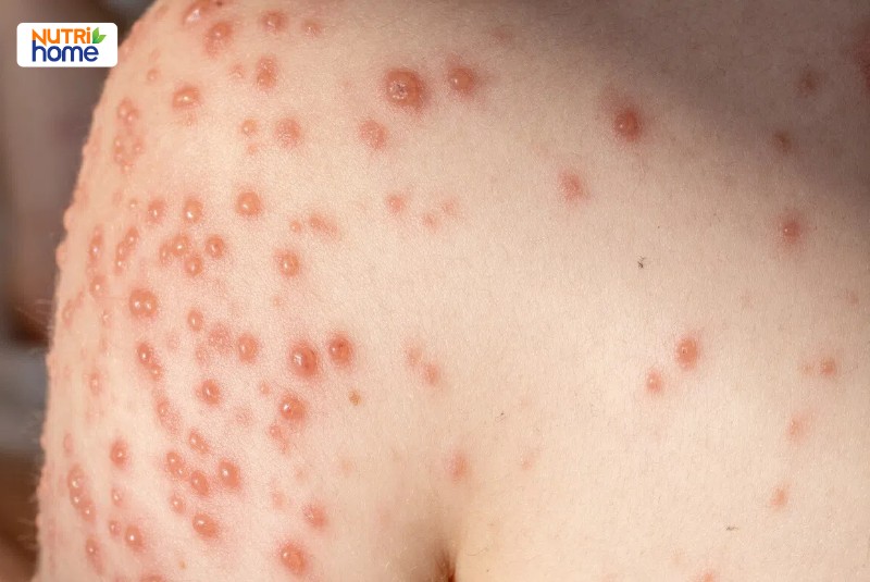 dấu hiệu bị thuỷ đậu ở người lớn
