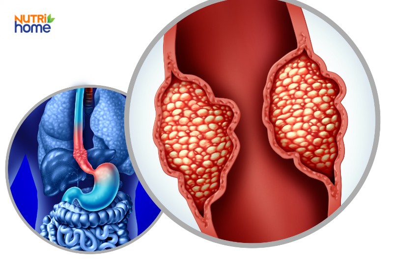 ung thư thực quản là bị bệnh gì