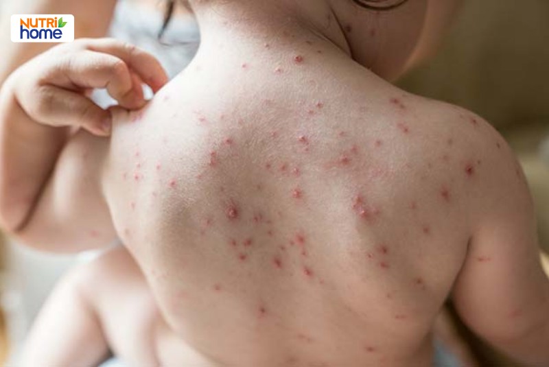 giá vacxin thuỷ đậu