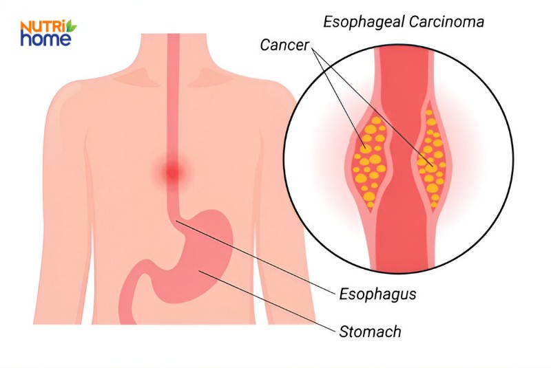 Các bệnh lý thường gặp ở thực quản