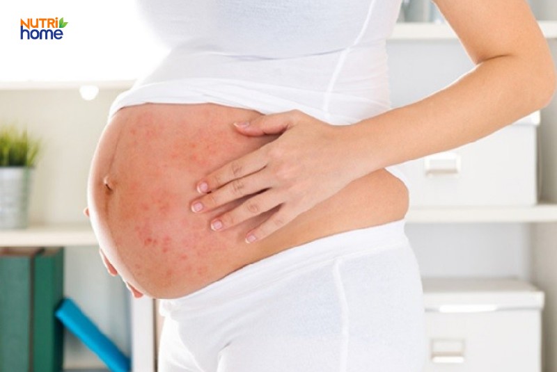 thuỷ đậu người lớn