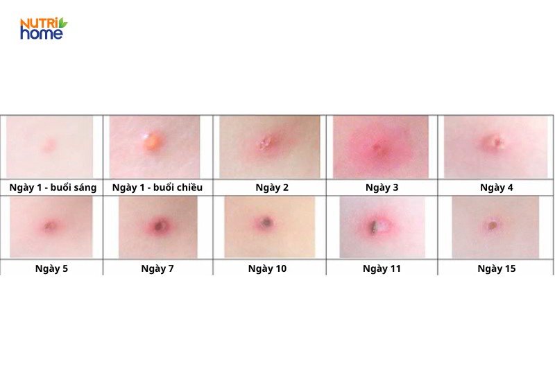 triệu chứng thủy đậu