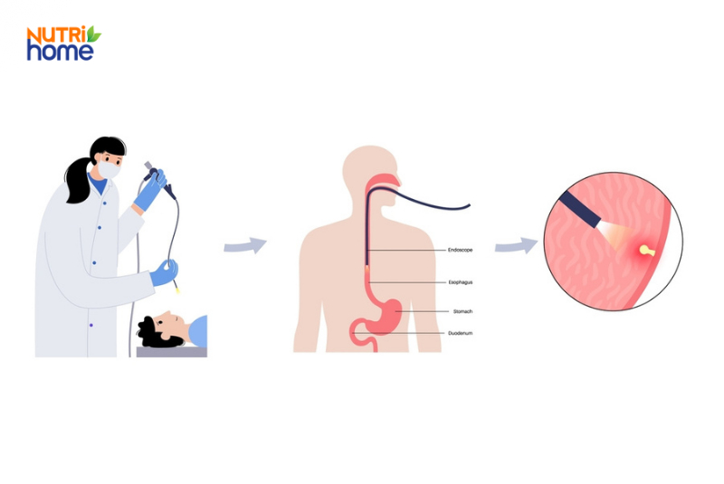 Chẩn đoán ung thư thực quản