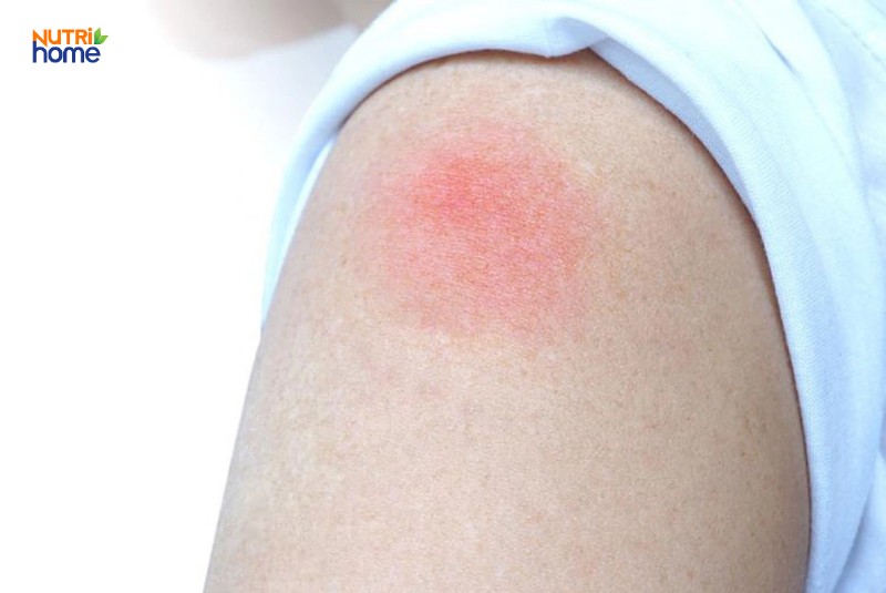 Tác dụng phụ của vacxin uốn ván