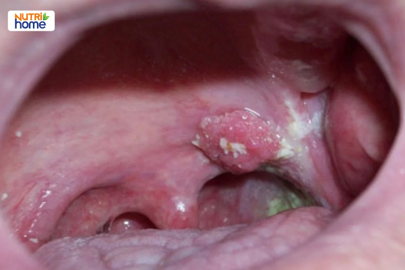 HPV type 11 gây bệnh gì