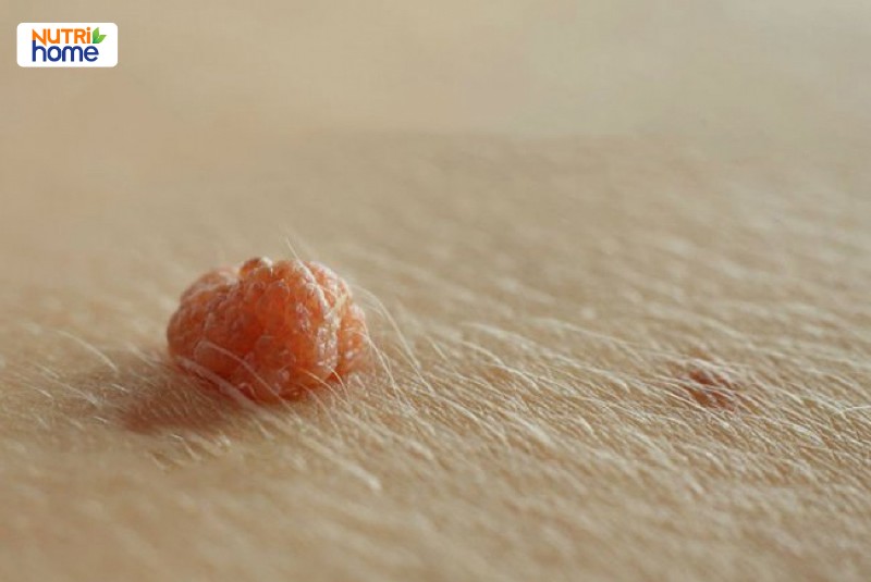 HPV type 6 gây bệnh gì