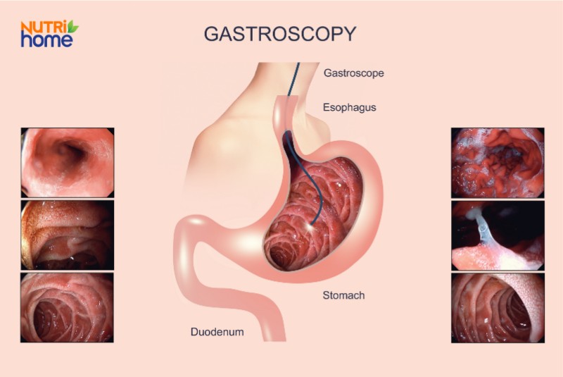 rối loạn tiêu hóa là gì