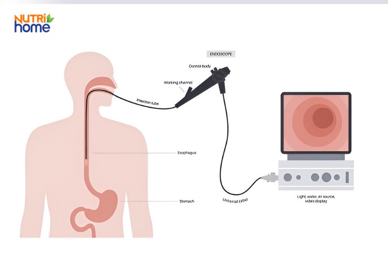 bệnh giãn tĩnh mạch thực quản