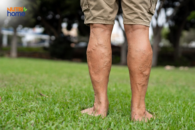 bệnh suy giãn tĩnh mạch