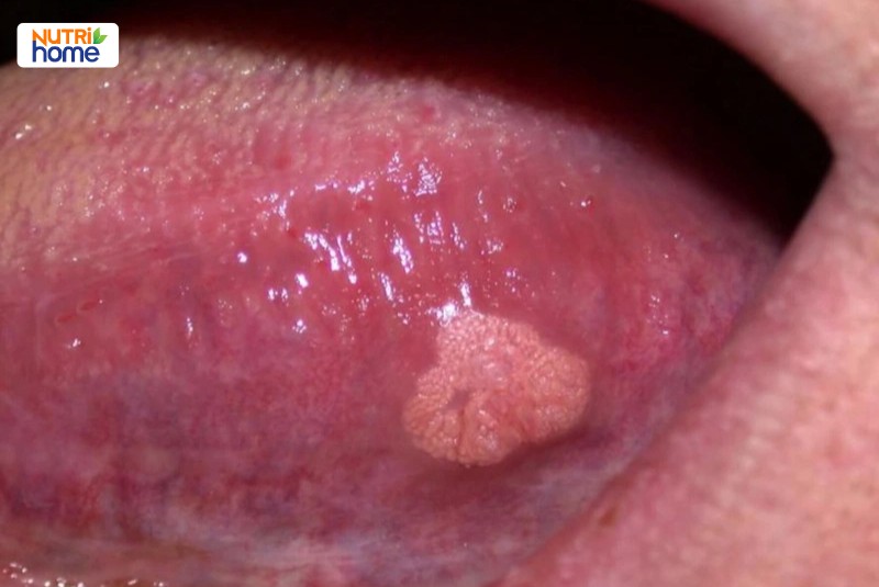 Mụn cóc sinh dục do HPV tuýp 6 và 11 gây ra ở vùng niêm mạc sinh dục