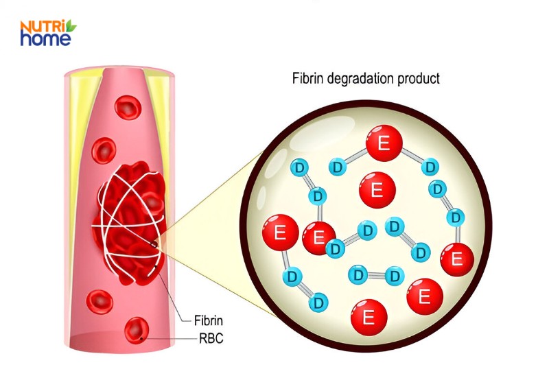 suy giãn tĩnh mạch